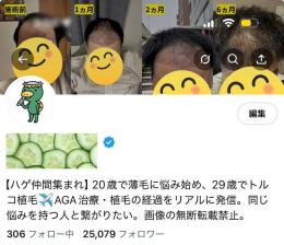 ⭐希少【フォロワー約２.５万人】AGA・植毛・薄毛治療・育毛 / 良質垢
